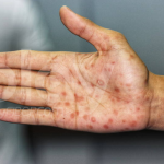 Alerta por la sífilis en Argentina: los diagnósticos en mujeres aumentaron un 26 % y crecen las reinfecciones